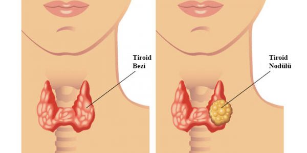 tiroid nodulleri doc dr serkan teksoz